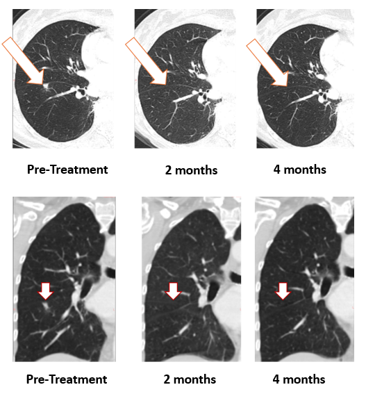 Treatment with Bria-OTS monotherapy resulted in 100% resolution of a breast cancer tumor in the lung of the metastatic breast cancer (MBC) patient following 2 months of therapy and confirmed at 4 months of therapy (axial and coronal views)