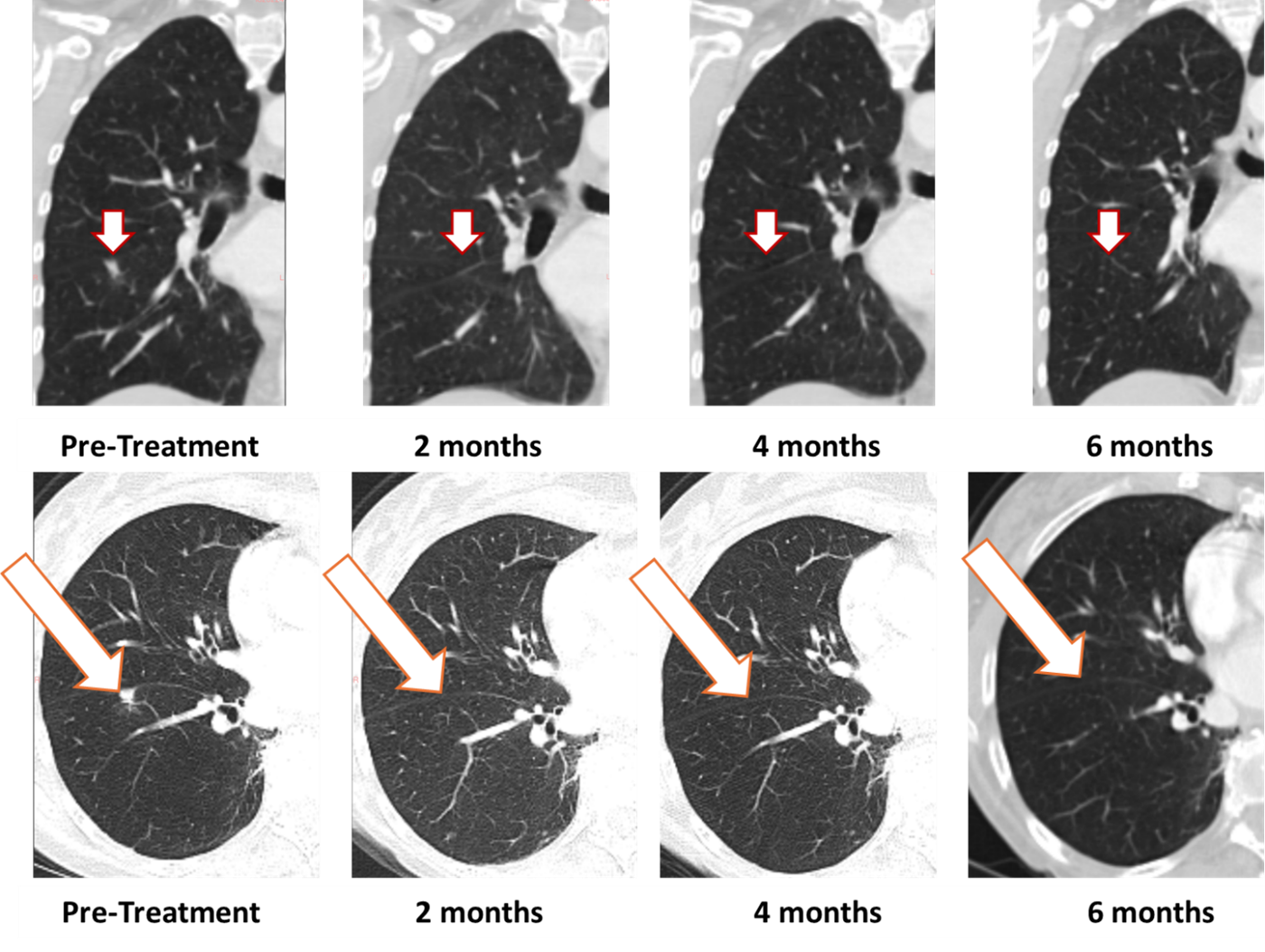 Treatment with Bria-OTS monotherapy resulted in 100% resolution of tumor in the right lung of the metastatic breast cancer (MBC) patient following 2 months of therapy and confirmed at 4, and 6 months of therapy (axial and coronal views)